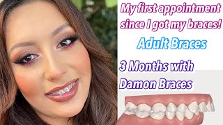 3 MONTH BRACES UPDATE  Damon Braces OverjetOverbite  Adult Braces [upl. by Dust277]