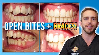 Open Bite Braces Treatment BEFORE amp AFTER [upl. by Raseac961]