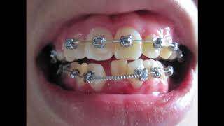 Braces  Before and After Time Lapse [upl. by Lusa]