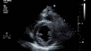 Hypokinesis Mitral Regurgitation Aortic Insufficiency [upl. by Haziza]