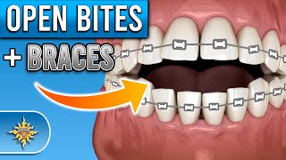 How Do Braces Fix Open Bites  Premier Orthodontics [upl. by Erdnael]