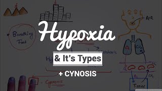 Hypoxia amp Cyanosis Causes amp PathogenesisTypes of Hypoxia Hypoxic  Anemic  Stagnant  Histotoxic [upl. by Colly]