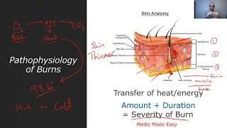 Burns  Pathophysiology Rule of 9s and Parkland Formula fluid resuscitation [upl. by Airalednac550]