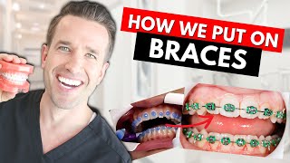 How Braces are Put On  Part IV Dr Nate [upl. by Barth]