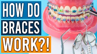 How Do Braces Work [upl. by Alemap432]