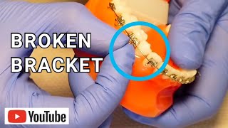 Broken Braces Broken Loose or Sliding Bracket What To Do [upl. by Adniram]