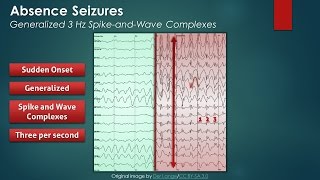 Epilepsy Complex Focal Seizure [upl. by Edee]