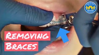 How Do BRACES FIX Overbites  Overbite Before and After Braces  Premier Orthodontics [upl. by Battista]