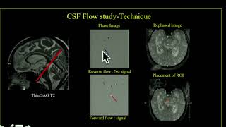 TMT CSF Flow Studies Part IV Normal Pressure Hydrocephalus [upl. by Amahs]