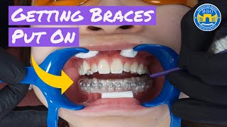 Process of Getting Braces [upl. by Sualk]