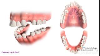 4 First Premolar Extraction for Retraction  Orthodontic Treatment [upl. by Ackerman]