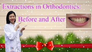 Extractions in Orthodontics Before and After [upl. by Nivan]