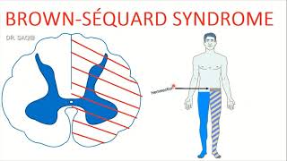 Brownsequard syndrome  Hemisection of the spinal cord [upl. by Gingras89]